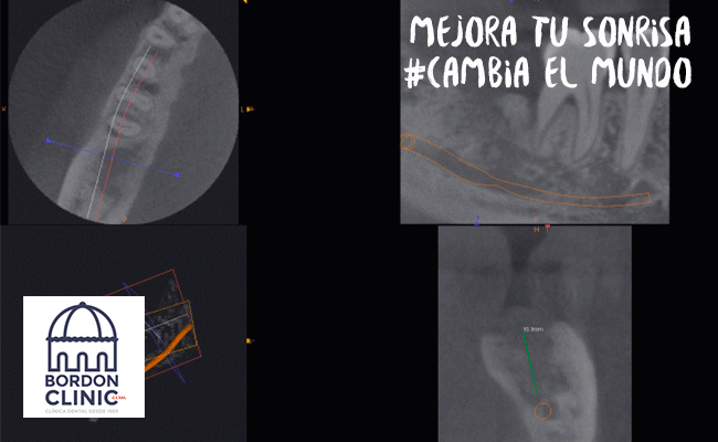 Tac Dental Clinica dental Madrid Bordonclinic