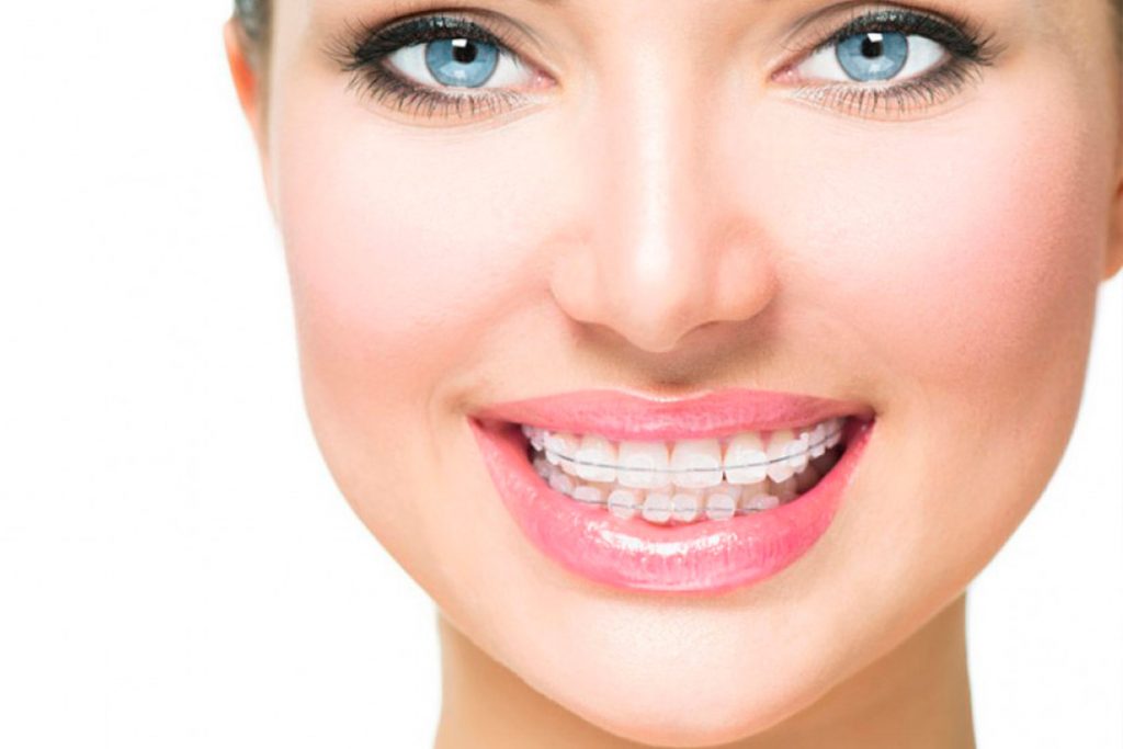 Brackets De Zafiro: Ventajas, Precio Y Opiniones - BORDONCLINIC