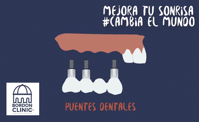 Puente Dental Precio Bordonclinic