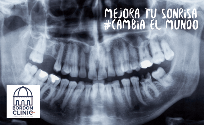 INJERTO EN BLOQUE DE HUESO