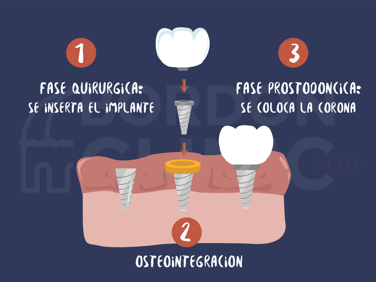 Implantes Osteointegrados Implantes Dentales Madrid - Implantes Dentales Precio Desde 550€ - BordonClinic