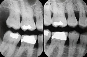 piorrea-radiografia