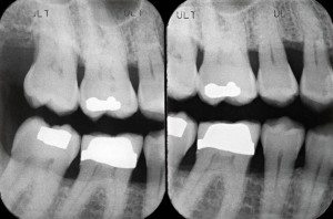 Piorrea-radiografia