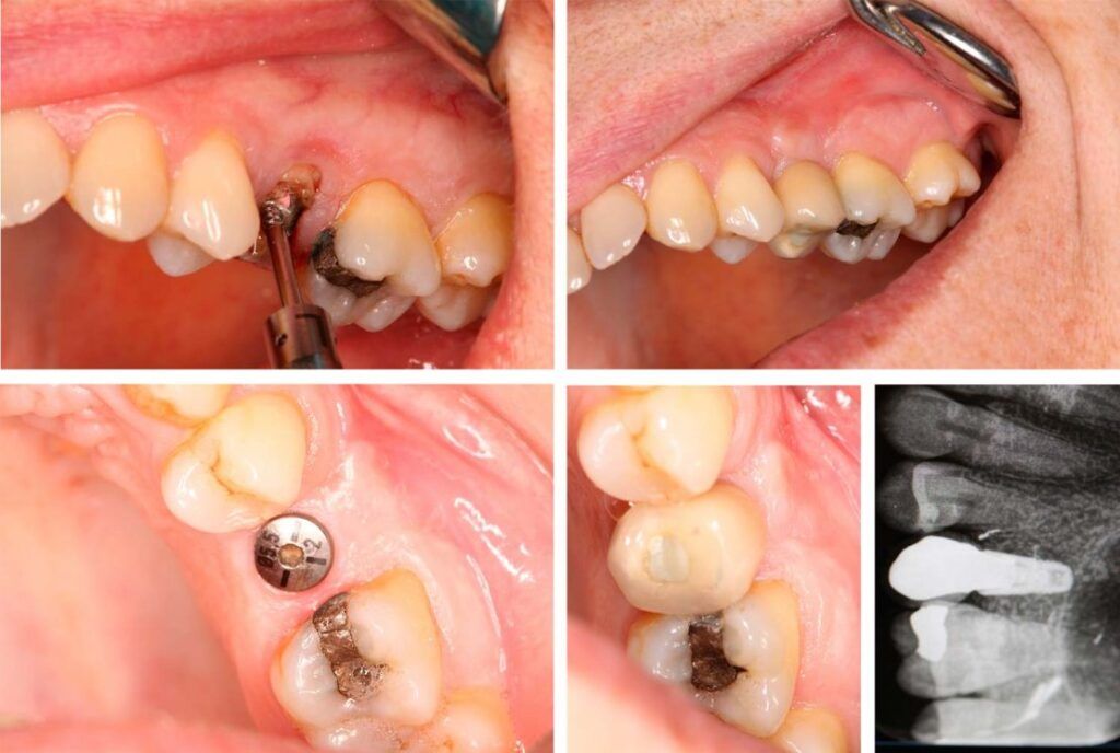 implantes dentales con corona - implante dental unitario - Clínica dental Madrid centro BORDONCLINIC