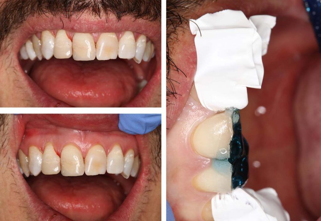 Carillas De Composite - Clínica Dental Bordonclinic