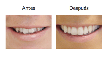 MIkala antes y después Invisalign MIkala antes y después Invisalign