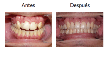 INVISALIGN MADRID: ORTODONCIA TRANSPARENTE Caso antes y depues INVISALIGN MADRID: ORTODONCIA TRANSPARENTE Caso antes y depues