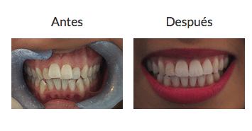 INVISALIGN MADRID: ORTODONCIA TRANSPARENTE CASO INVISALIGN MADRID: ORTODONCIA TRANSPARENTE CASO