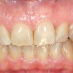 Blanqueamiento Dental Laser