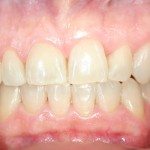 Blanqueamiento Dental Laser