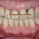 Diseño de sonrisa digital - Digital Smile Design (DSD Madrid)