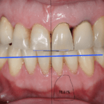 Diseño de sonrisa digital - Digital Smile Design (DSD Madrid)