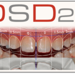 Diseño De Sonrisa Digital - Digital Smile Design (DSD Madrid)