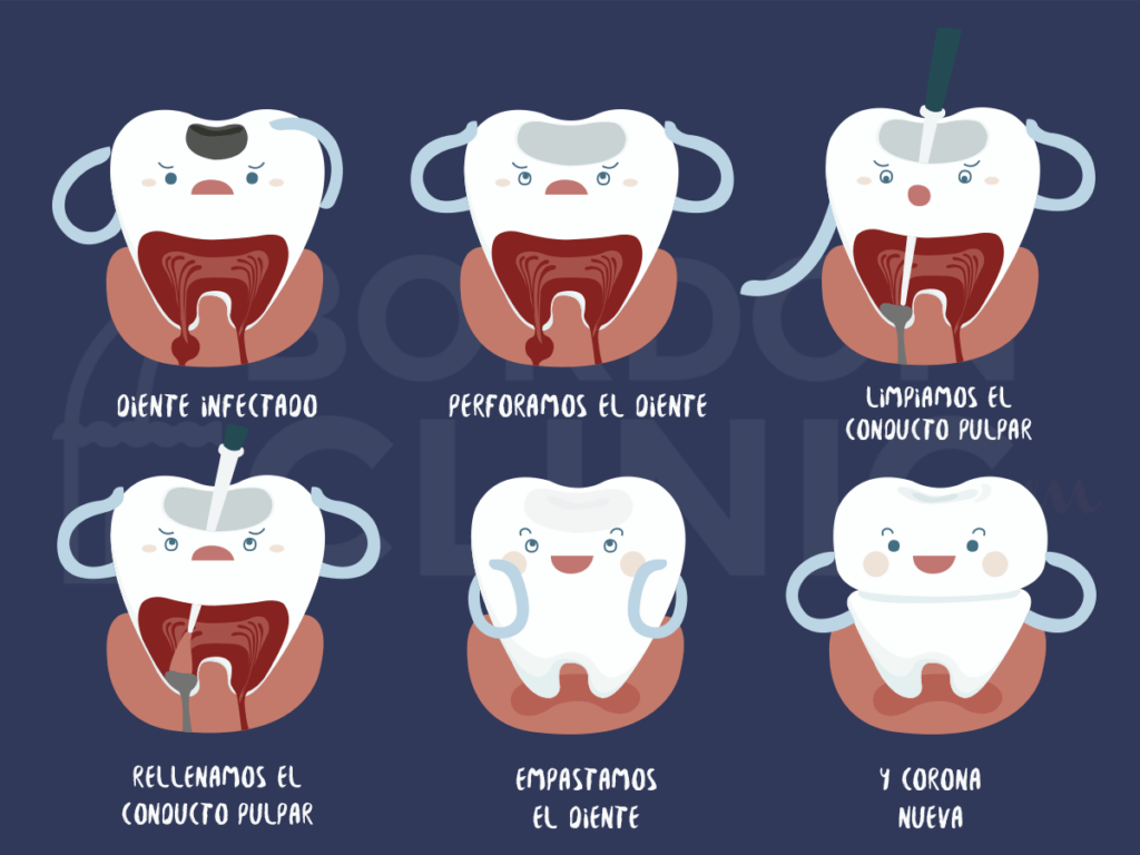 Fases De Una Endodoncia Infografia