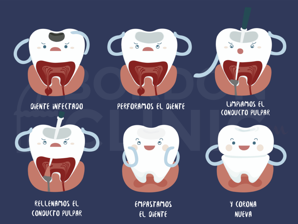 Fases de una endodoncia infografia