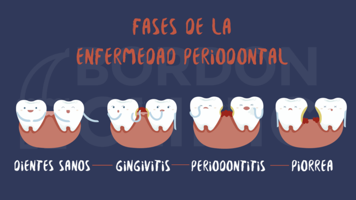 Fases de la Enfermedad Periodontal