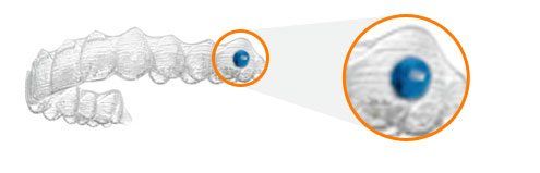 Invisalign Teen: Ortodoncia Para Adolescentes Aligners Especiales Invisalign Teen: Ortodoncia Para Adolescentes Aligners Especiales