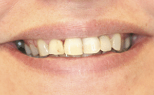 Carillas_dentales_lumineers_precio_antes