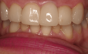 Carillas_dentales_lumineers_precio_cerca_despues