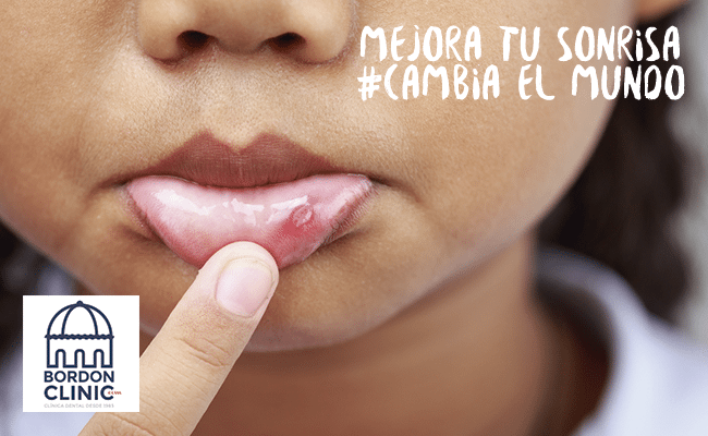 Aftas: ponemos el dedo en la llaga, la estomatitis aftosa