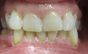 antes_invisalign