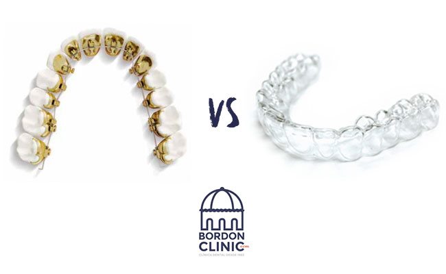 ORTODONCIA LINGUAL VS ORTODONCIA INVISALIGN