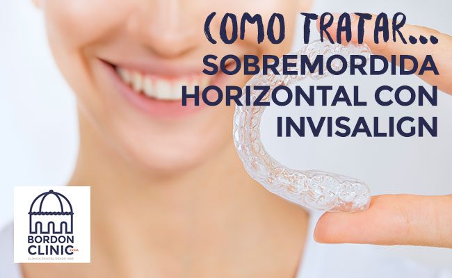 SOLUCIONAR UNA SOBREMORDIDA HORIZONTAL CON INVISALIGN