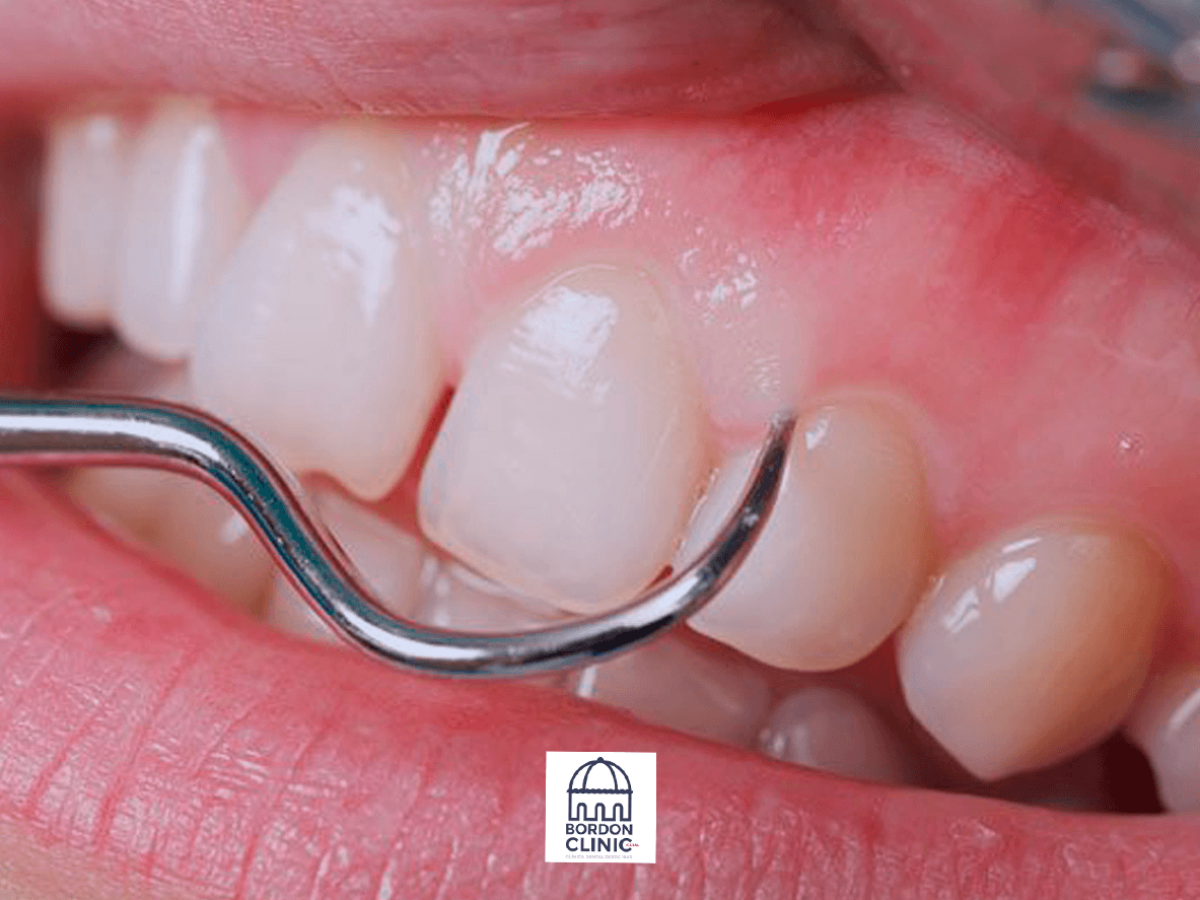 abscesos dentales sintomas de diabetes