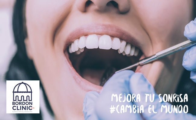 encías retraídas - retracción de encías