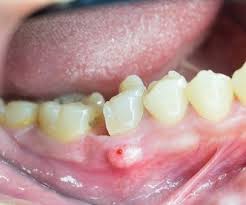 absceso dental