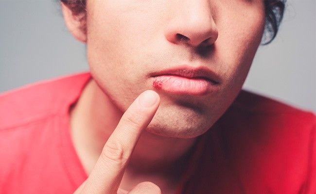 herpes labial