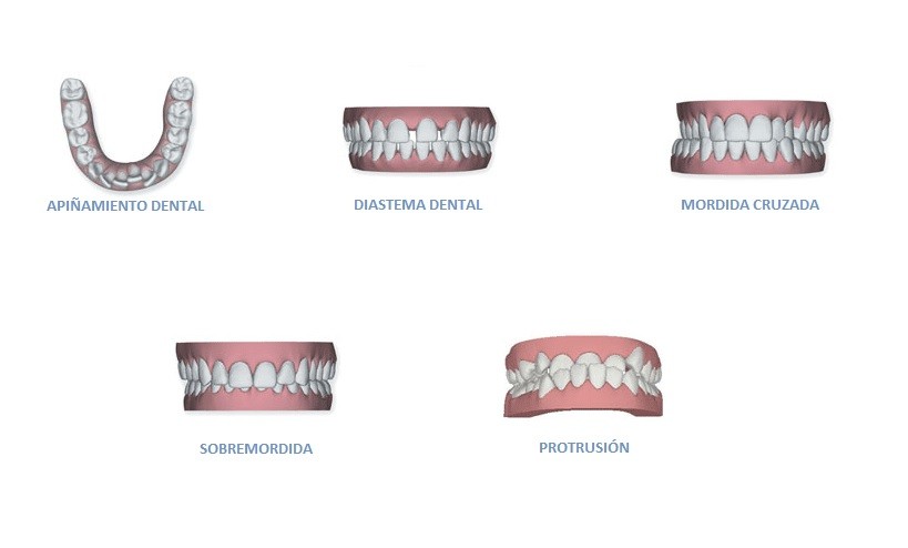 Invisalign: Ortodoncia Invisible Patologías Invisalign Adultos