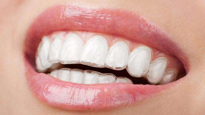 Invisalign Lite - Bordonclinic