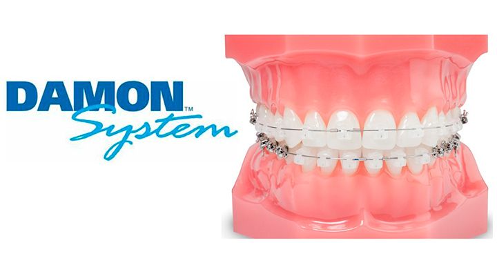 Brackets Autoligables - Clínica Dental BordonClinic