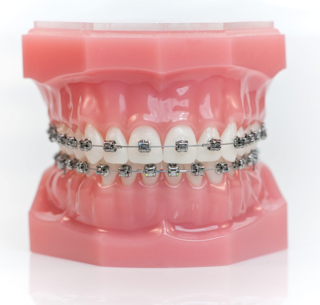 Brackets Autoligables - Clínica Dental BordonClinic