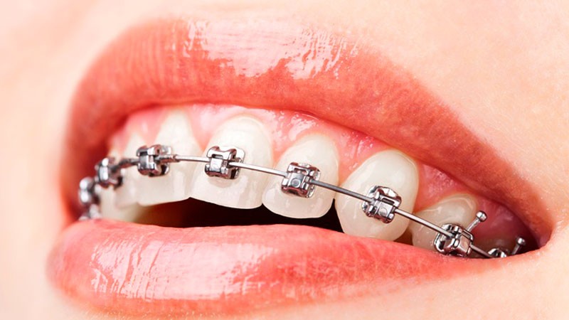 Brackets Autoligables Brackets Autoligables Madrid - Invisalign Precio - Ortodoncia Invisible - - Clínica Dental Madrid Centro BORDONCLINIC