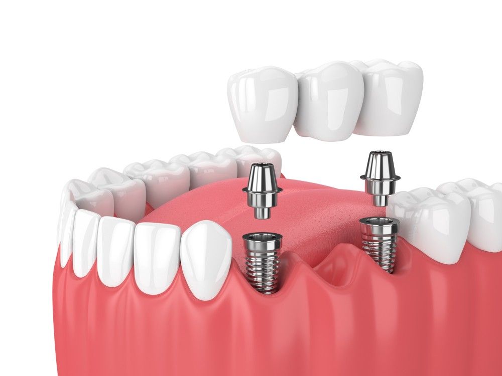 Puente Dental - Tipos - Bordonclinic