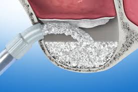 Injerto De Hueso Injerto De Hueso - Clínica Dental Bordonclinic