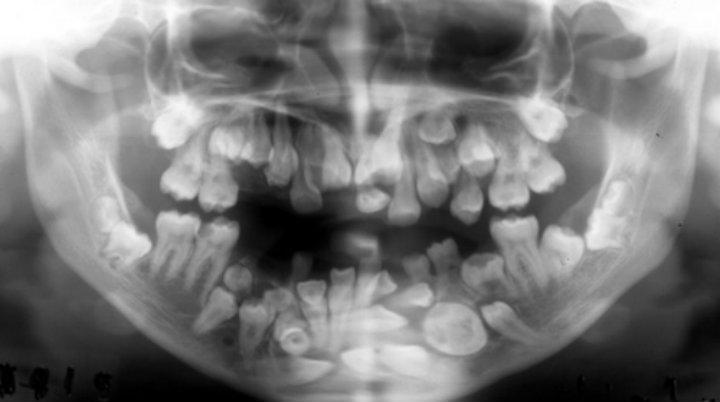 dientes supernumerarios o hiperodoncia
