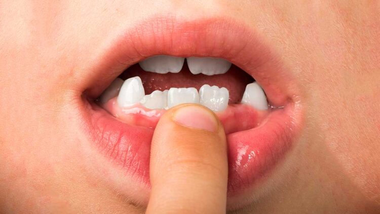 Qué es la agenesia dental