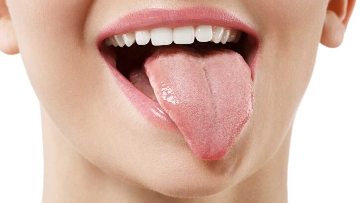 Causas de la lengua amarilla
