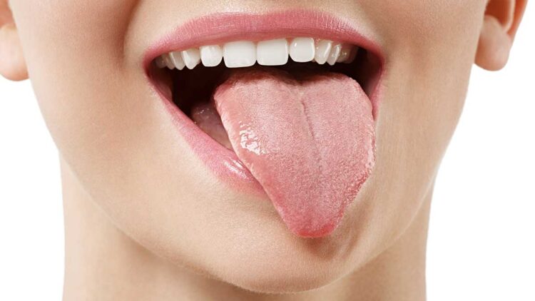Causas de la lengua amarilla