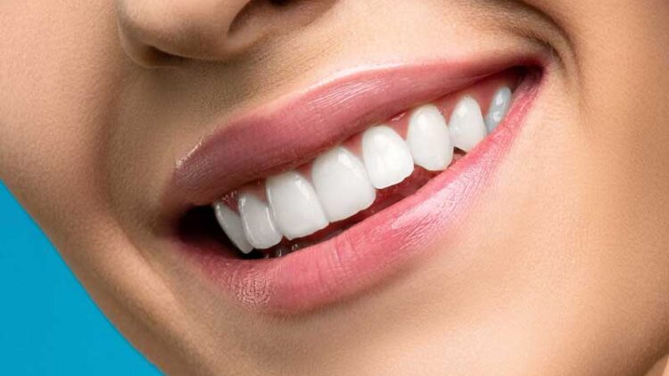 Cómo tener una sonrisa perfecta