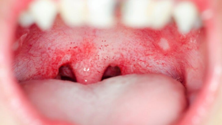 Manchas Rojas En El Paladar - Clínica Dental BordonClinic