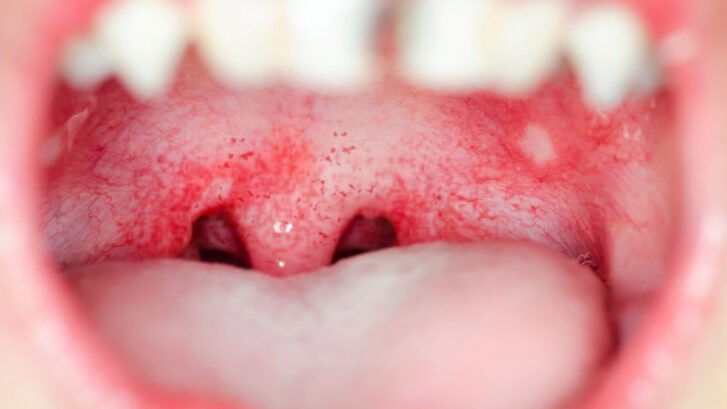 Manchas rojas en el paladar | BordonClinic