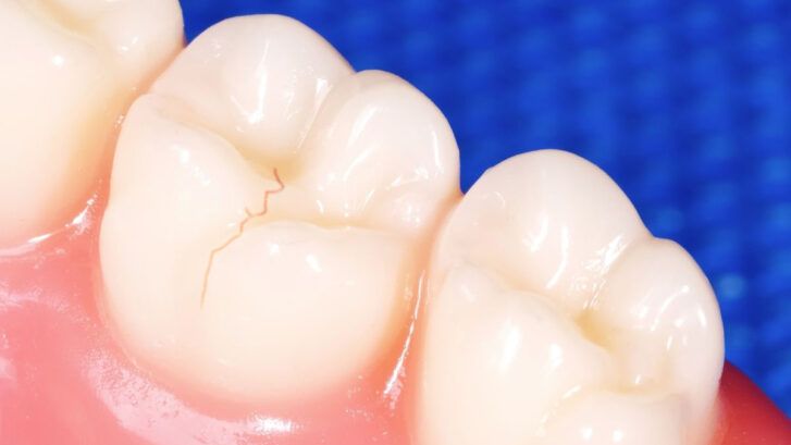 Fisuras dentales: ¿cómo tratarlas? | BordonClinic