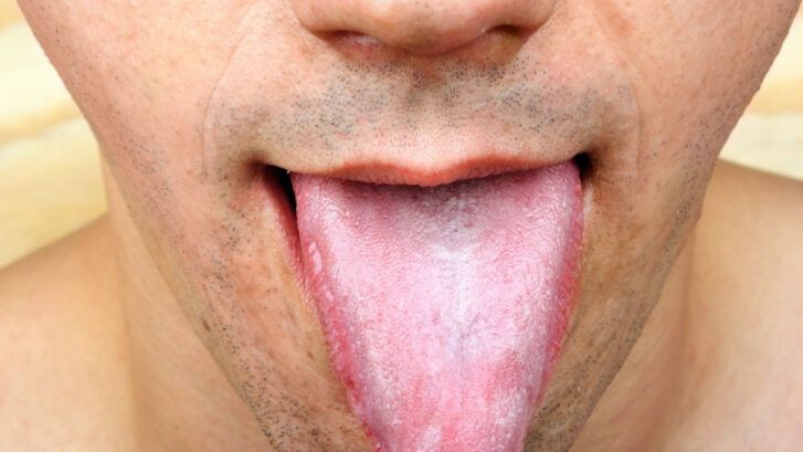 Papilitis lingual: descubre sus tipos y tratamiento | BordonClinic