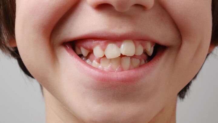 Protrusión Dental: Qué Es Y Cómo Tratarla - Clínica Dental Bordonclinic