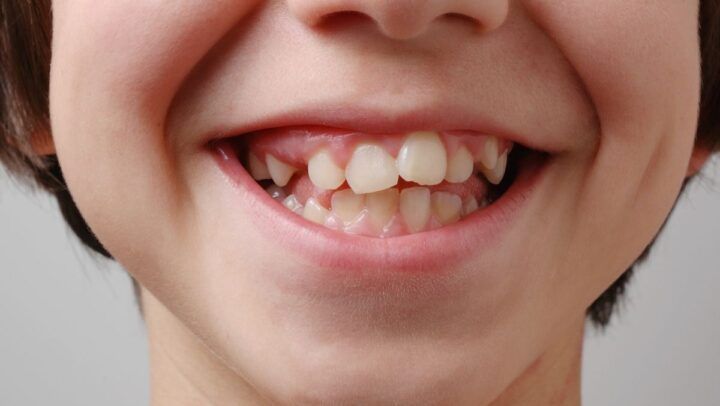 Protrusión Dental: Qué Es Y Cómo Tratarla Protrusión Dental: Qué Es Y Cómo Tratarla - Clínica Dental Bordonclinic