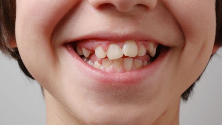 Protrusión dental: qué es y cómo tratarla | BordonClinic